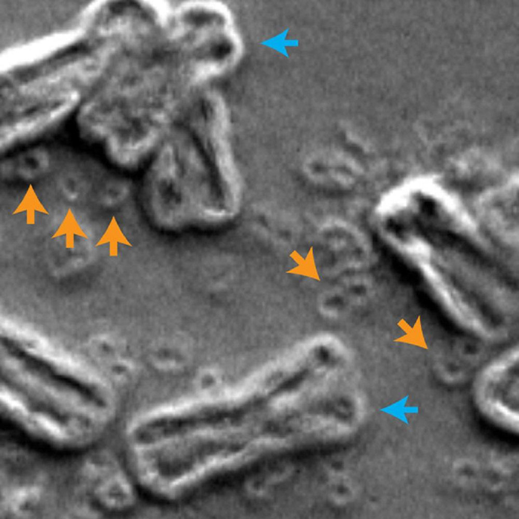 Image: Scanning electron micrograph of inside the nucleus of a cancer cell, chromosomes are indicated by blue arrows and circular extrachromosomal DNA are indicated by orange arrows (Photo courtesy of Paul S. Mischel, MD, UC San Diego)