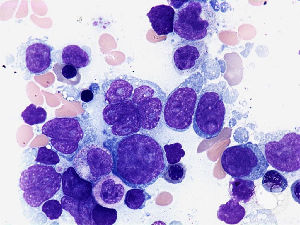Image: Micrograph of a diffuse large B cell lymphoma, from a bone marrow aspirate; the nucleus may be convoluted and irregular (Photo courtesy of Peter Maslak)
