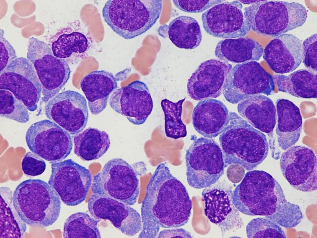 Image: Photomicrograph of bone marrow aspirate of a pediatric patient with acute myeloid leukemia (Photo courtesy of St. Jude Children's Research Hospital).