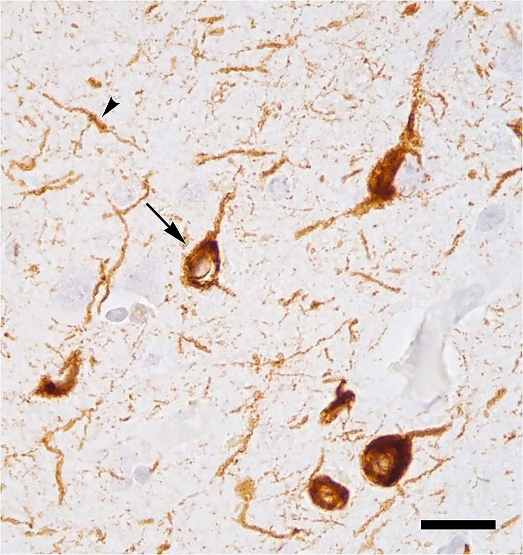 Image: Abnormal accumulation of tau protein in neuronal cell bodies (arrow) and neuronal extensions (arrowhead) in the neocortex of a patient who had died with Alzheimer's disease (Photo courtesy of Wikimedia Commons)