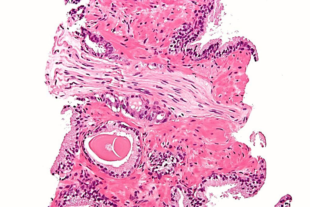 Image: Photomicrograph of a histological biopsy of a prostatic adenocarcinoma, conventional (acinar) type, the most common form of prostate cancer (Photo courtesy of Nephron).