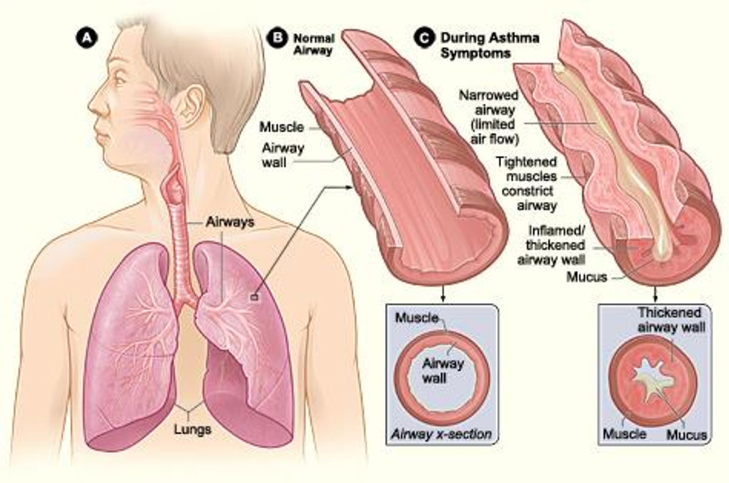 Image: Figure A shows the location of the lungs and airways in the body. Figure B shows a cross-section of a normal airway. Figure C shows a cross-section of an airway during asthma symptoms (Photo courtesy of [U.S.] National Institute of Health: National Heart, Lung, Blood Institute)