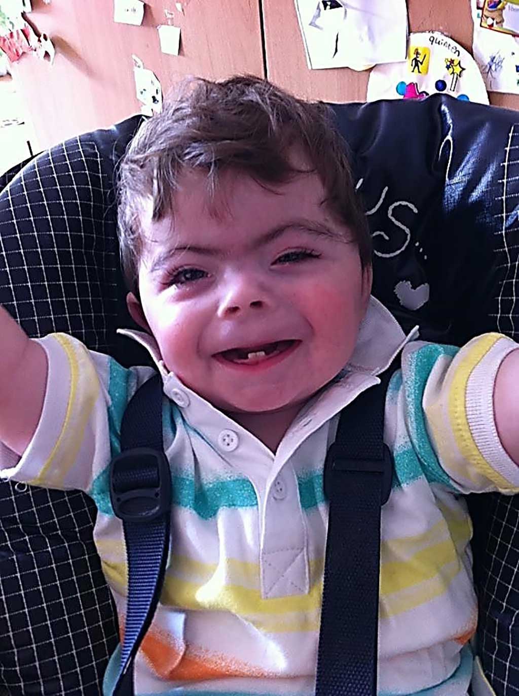 Image: One year old boy with Cornelia de Lange syndrome (Photo courtesy of the University of Washington).