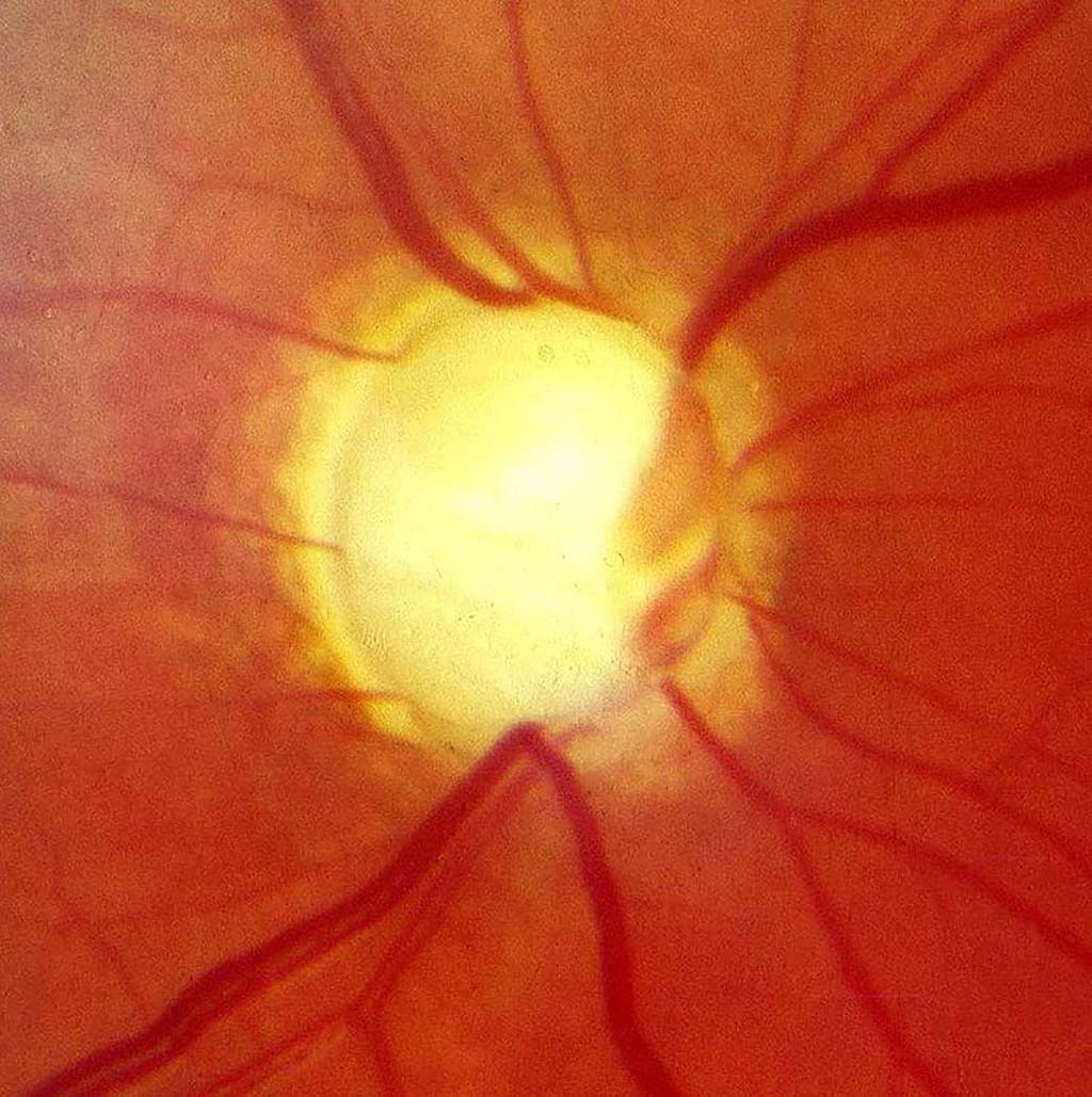Image: Optic nerve in advanced glaucoma disease (Photo courtesy of Wikimedia Commons)