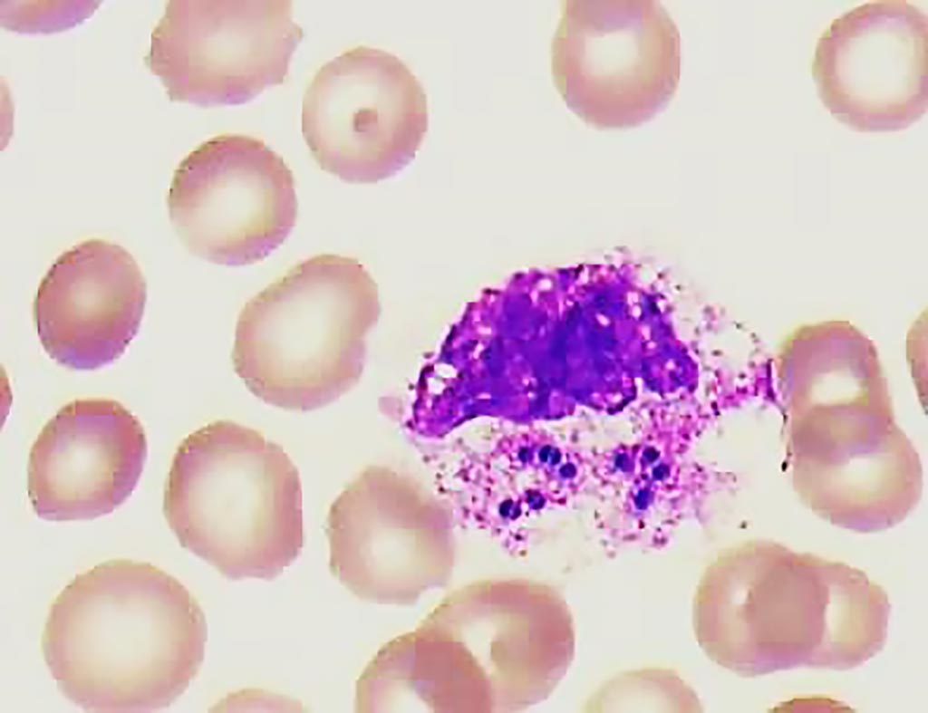Image: Blood smear of patient with intracellular cocci in pairs inside a white blood cell, possibly indicating sepsis. Oncostatin-M is a biomarker for sepsis risk (Photo courtesy of Dr. Wim van der Meer).