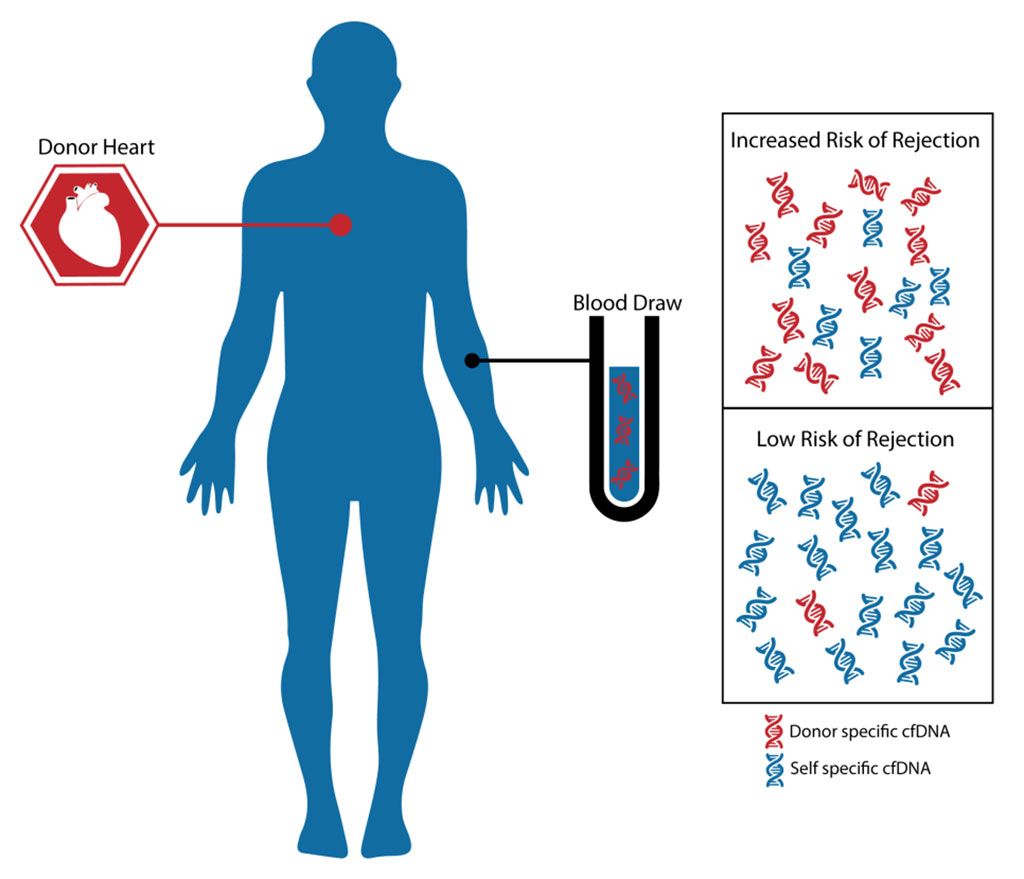 Image: The myTAIHEART test is a powerful non-invasive test that uses a small sample of blood to determine if a patient is at a low or increased risk of rejecting their heart transplant. myTAIHEART works by measuring the fraction of cell-free DNA (cfDNA) present in the bloodstream that is attributable to the transplanted heart. An elevated donor fraction (DF%) is associated with an increased risk of acute cellular rejection (Photo courtesy of TAI Diagnostics).