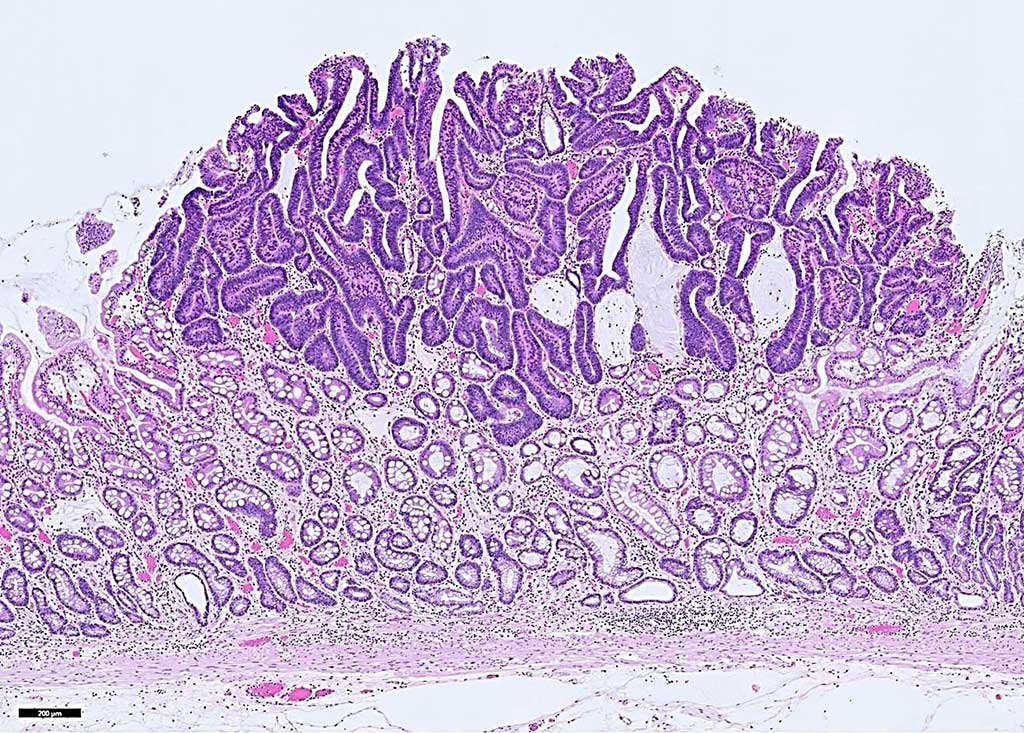 Image: Histopathology of early gastric cancer, an intramucosal adenocarcinoma. A blood test used in a targeted methylation (TM) sequencing assay may help detect hard-to-detect gastrointestinal cancers in asymptomatic individuals (Photo courtesy of Andrey Bychkov, MD, PhD).