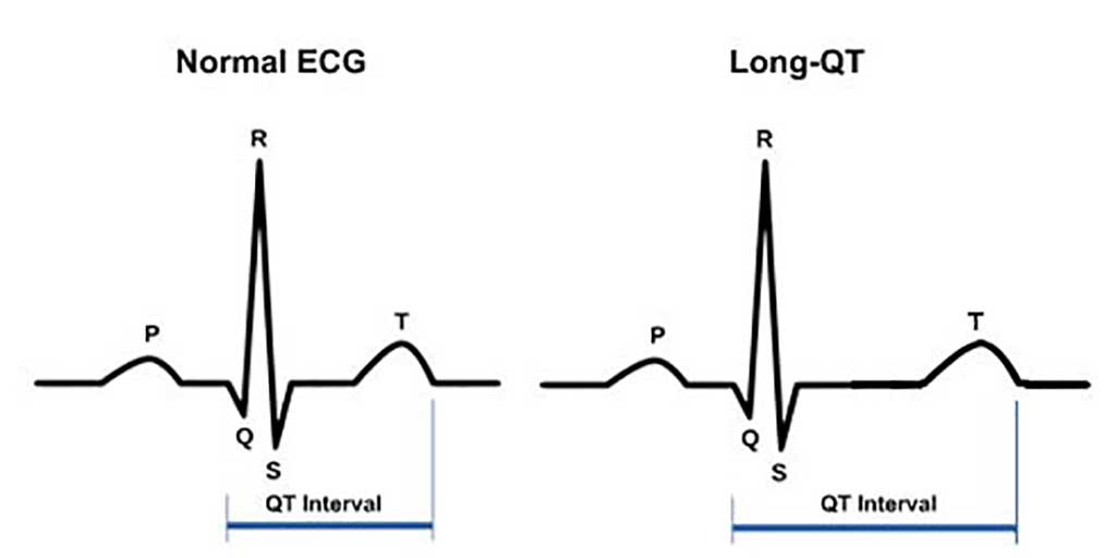 Image: Normal electrocardiogram (ECG) and an ECG showing QT interval prolongation (long QT syndrome). The P wave represents atrial depolarization; the QRS complex, ventricular depolarization; and the T wave, ventricular repolarization. The QT interval is measured from the beginning of the QRS complex to the return of the T wave to the isoelectric line (Photo courtesy of Mayo Clinic).