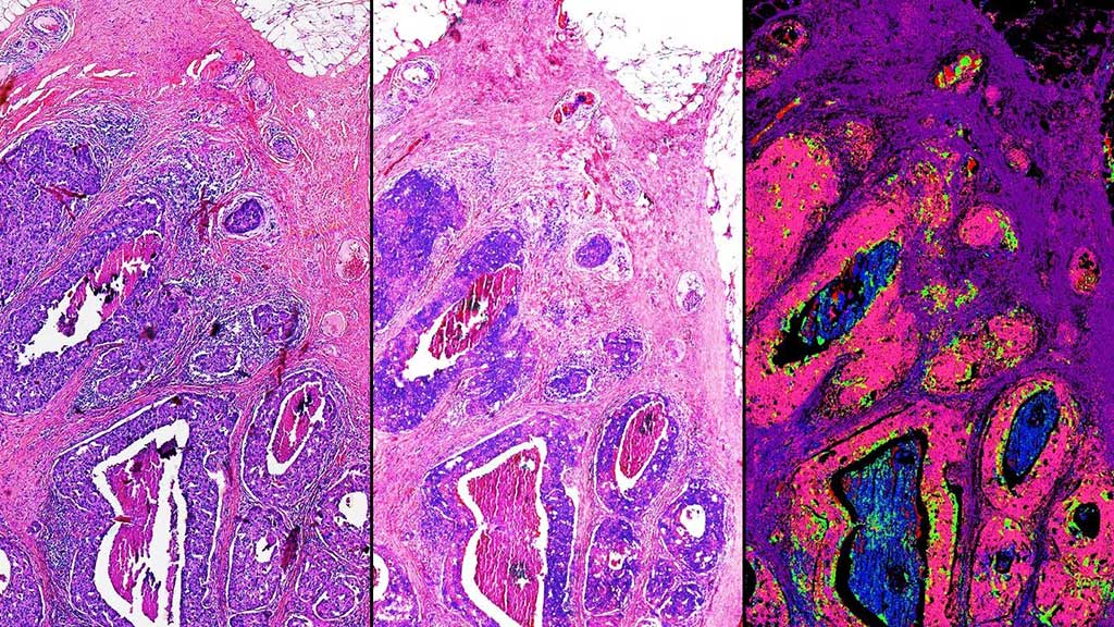 Image: This side-by-side comparison of a breast tissue biopsy demonstrates some of the infrared-optical hybrid microscope’s capabilities. On the left, a tissue sample dyed by traditional methods. Center, a computed stain created from infrared-optical hybrid imaging. Right, tissue types identified with infrared data. The pink in this image signifies malignant cancer (Photo courtesy of Rohit Bhargava, PhD).