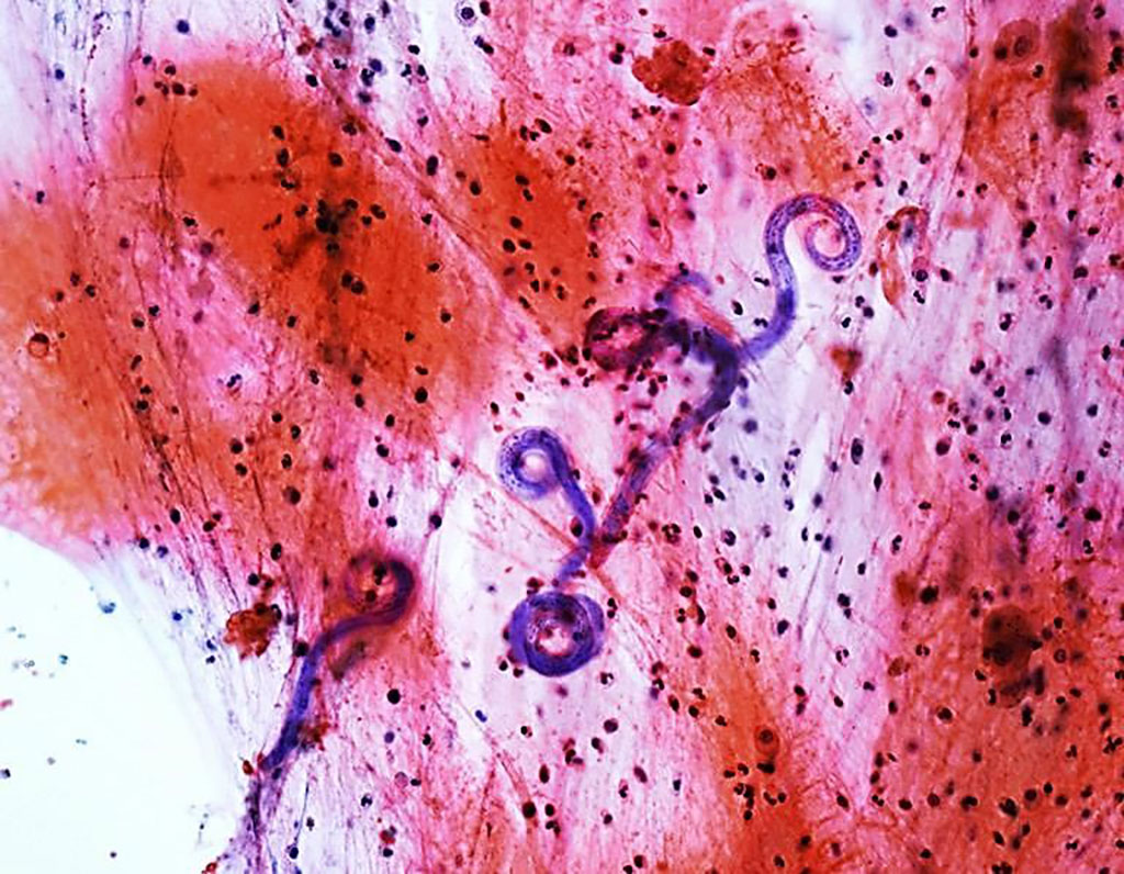 Image: Microscopic examination of bronchoalveolar lavage fluid revealing the presence of Strongyloides stercoralis larvae in hemorrhagic background (Photo courtesy Kyung-Nyeo Jeon, MD, PhD).