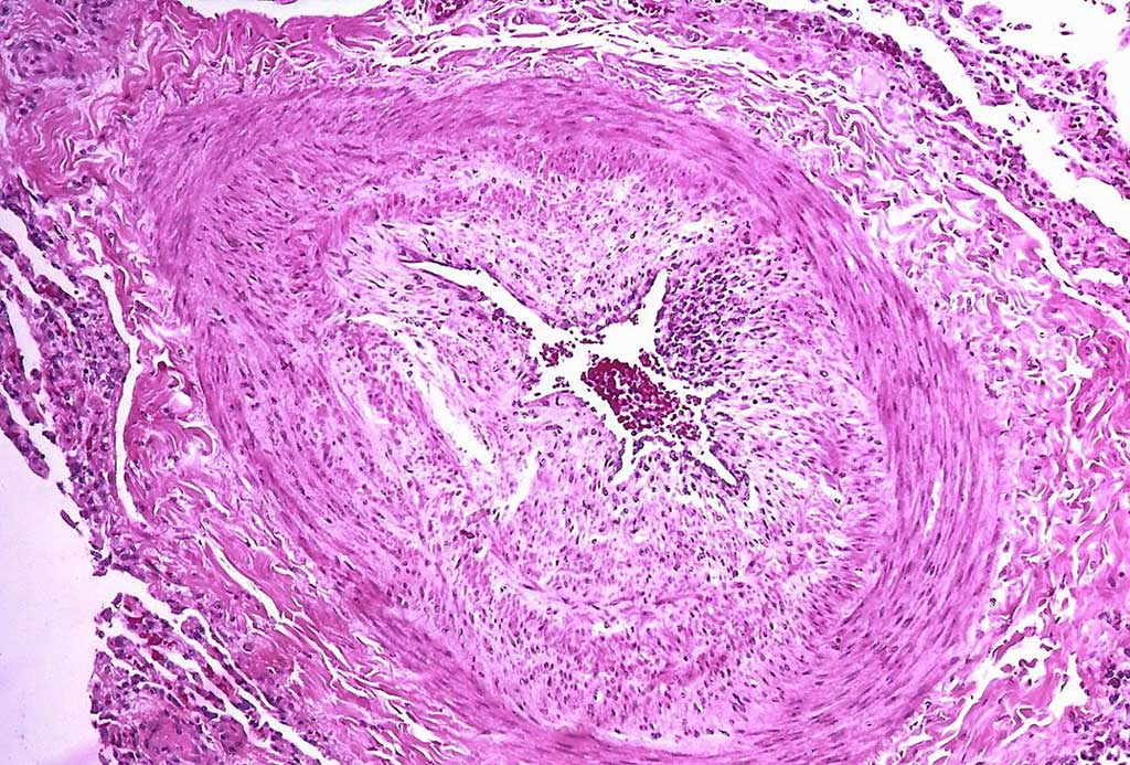 Image: Histopathology showing arteries of a patient with pulmonary arterial hypertension (PAH) with marked thickening of the walls. A unique profile of gut bacteria can predict the presence of pulmonary artery hypertension in patients with 83% accuracy (Photo courtesy of Yale Rosen, MD).