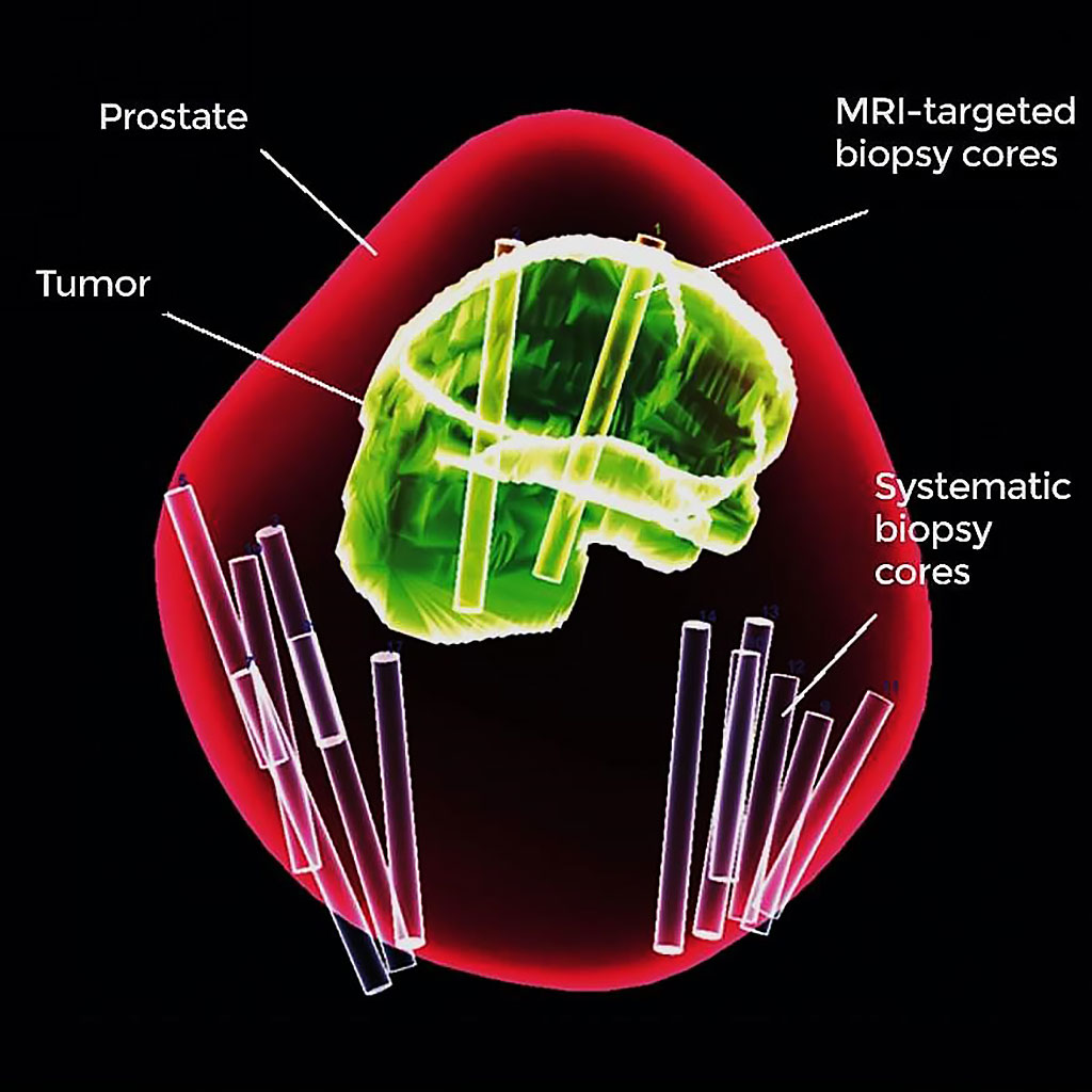 Image: Testing with combined biopsy method improves prostate cancer diagnosis (Photo courtesy of the National Institutes of Health Clinical Center).