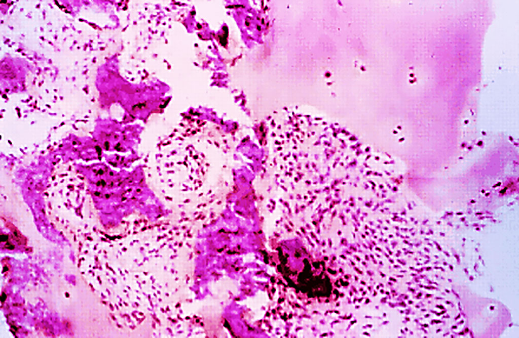 Image: Sacroiliac joint biopsy specimen of a 29 year old male patient with ankylosing spondylitis. The biopsy specimen shows a subchondral cellular infiltrate partly invading the cartilage. Fibroblasts and activated lymphocytes are seen in the infiltrate. In between are areas of calcification and bone formation (Photo courtesy of Professor J. Braun).