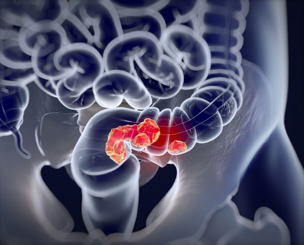 Image: Multitarget Stool DNA Screening has a high positive predictive value for colorectal neoplasia regardless of exposure to previous colonoscopy (Photo courtesy of Madeline Morr).