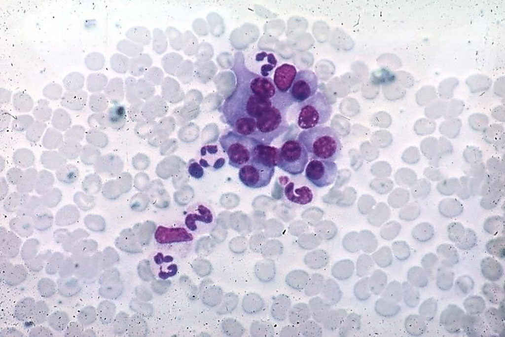 Image: Photomicrograph of normal plasma cells from a bone marrow aspirate (Photo courtesy of Peter Anderson).