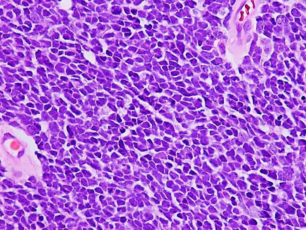 Image: Histopathology of classic medulloblastoma in the brain showing a diffuse pattern of tumor growth with poor cellular differentiation, nuclear molding, and minimal indistinct cytoplasm (Photo courtesy of Adekunle M. Adesina, MD, PhD)