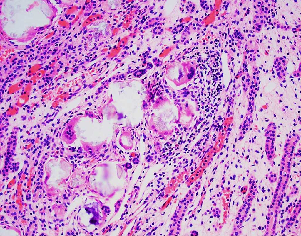 Image: Histology of multinucleated giant cells engulfing calcium oxalate crystals from a patient with type 1 primary hyperoxaluria (Photo courtesy of Jonathan E. Zuckerman, MD, PhD).