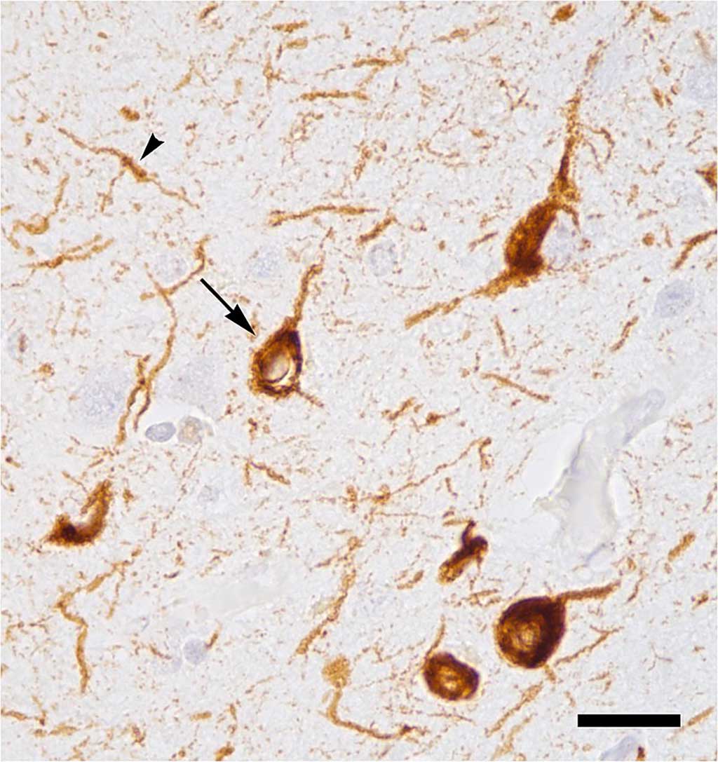 Image: Abnormal accumulation of tau protein in neuronal cell bodies (arrow) and neuronal extensions (arrowhead) in the neocortex of a patient who had died with Alzheimer`s disease (Photo courtesy of Wikimedia Commons).