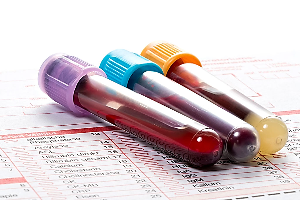 Image: Multicancer Blood Test Aids Screen for Cancer Guide Intervention (Photo courtesy of fotoquique/Depositphotos).