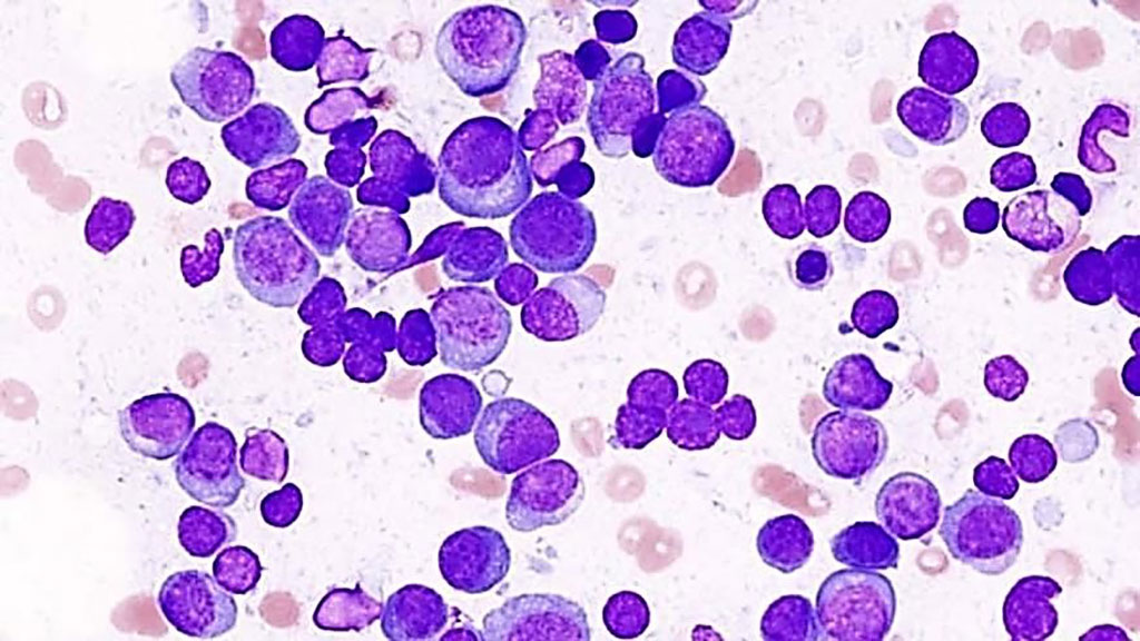 Image: Photomicrograph of multiple myeloma in a smear preparation of a bone marrow aspirate (Photo courtesy of the Institute of Cancer).