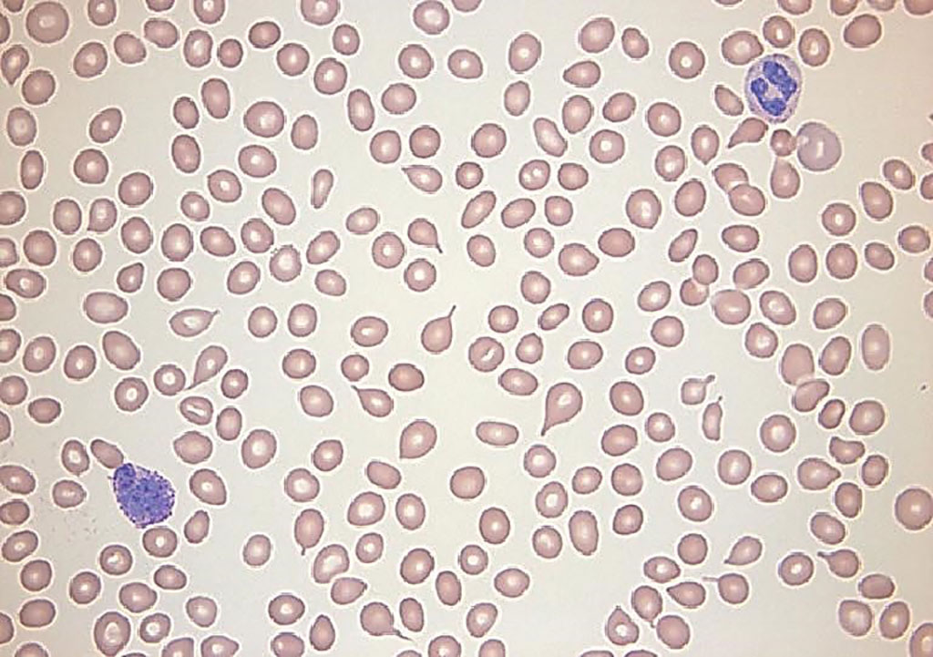 Image: A blood smear from a patient with microcytosis which may predict underlying cancer even in the presence of normal hemoglobin. Microcytic red blood cells measure 6 μm or less in diameter.  The mean corpuscular volume is generally less than 80 fL (Photo courtesy of Sara Beth Fazio, MD).