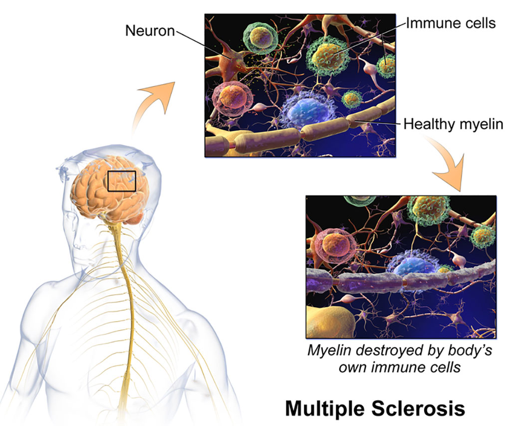 Image: Processes underlying multiple sclerosis (Photo courtesy of Wikimedia Commons)