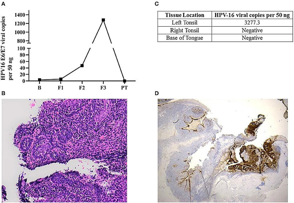 Image: Left panel: Histological sections of the left tonsillar tissue found a 2 mm non-keratinizing squamous cell carcinoma, with focal stromal invasion  comparing non-affected area in the left tonsil (Photo courtesy of Queensland University of Technology).