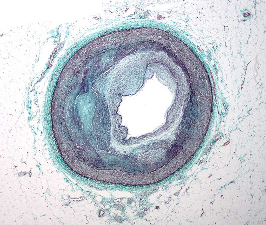 Image: Micrograph of a coronary artery with the most common form of coronary artery disease (atherosclerosis) and marked luminal narrowing (Photo courtesy of Wikimedia Commons)