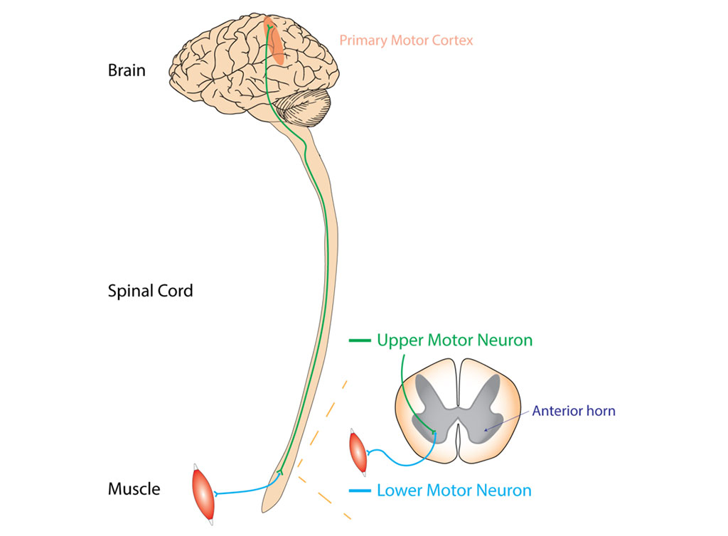 Image: Typical or `classical` ALS involves neurons in the brain (upper motor neurons) and in the spinal cord (lower motor neurons) (Photo courtesy of Wikimedia Commons)
