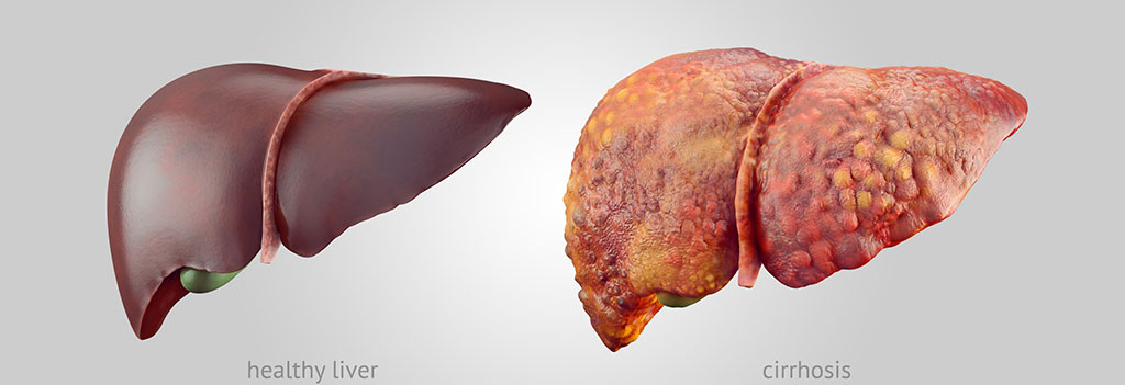 Image: Illustration depicts a healthy liver (left) and a liver with cirrhosis (Photo courtesy of [U.S.] National Institute of Diabetes and Digestive and Kidney Diseases)