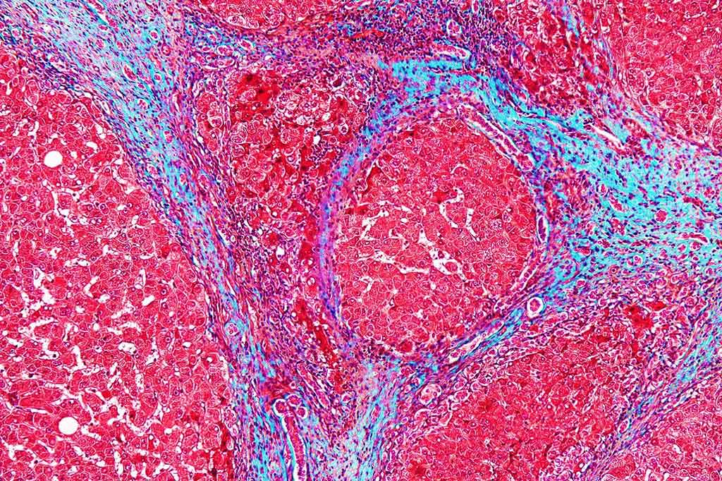 Image: High magnification photomicrograph of a liver with cirrhosis (Photo courtesy of Nephron).