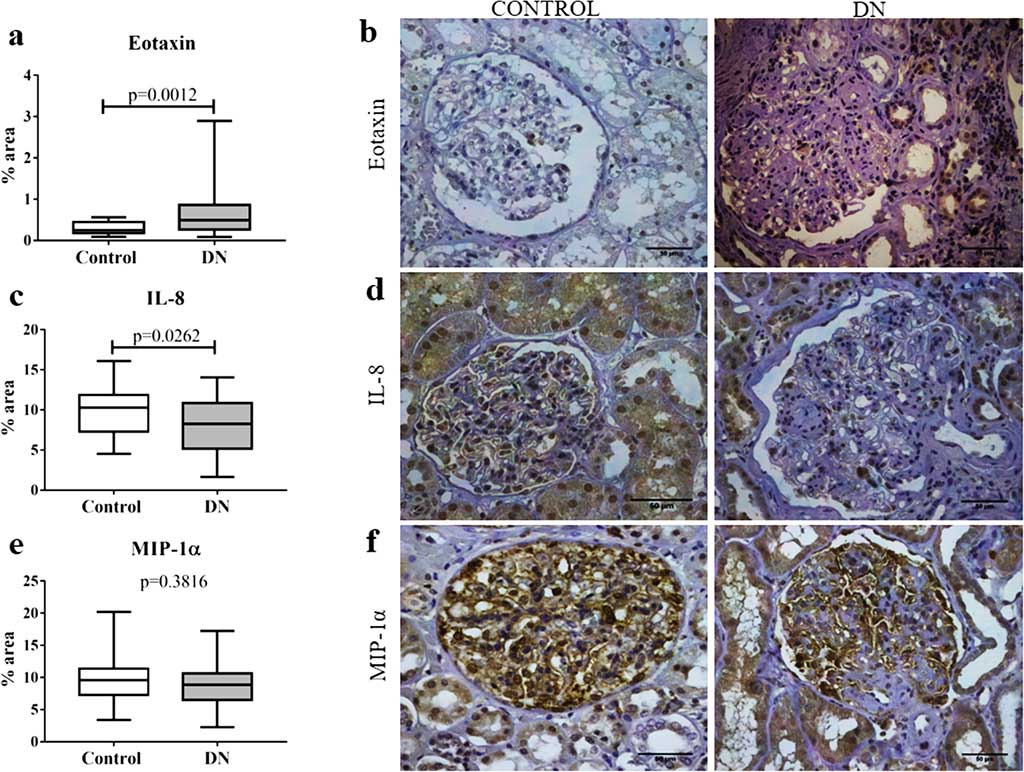 In situ expression of chemokines eotaxin, IL-8, and MIP-1α in glomerular and tubulointerstitial compartments in patients with diabetic nephropathy (DN) and control group (Photo courtesy of Federal University of Triângulo Mineiro).