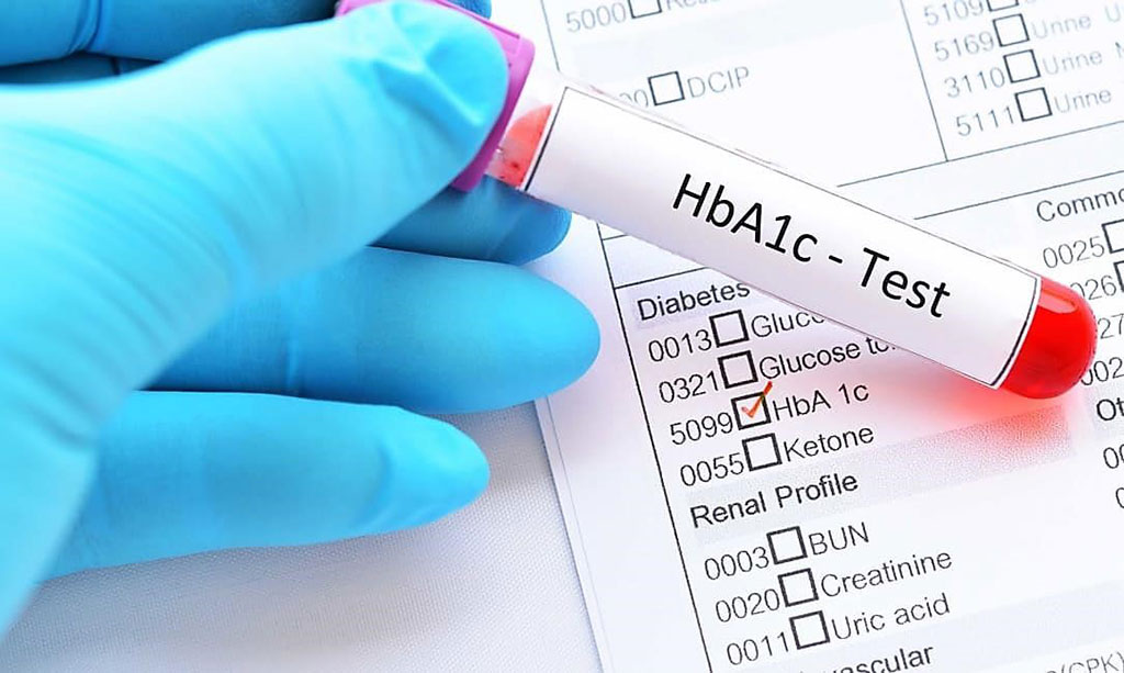 By measuring glycated hemoglobin (HbA1c), clinicians are able to get an overall picture of what the average blood sugar levels have been over a period of weeks/months (Photo courtesy of Diabetes.co.uk).