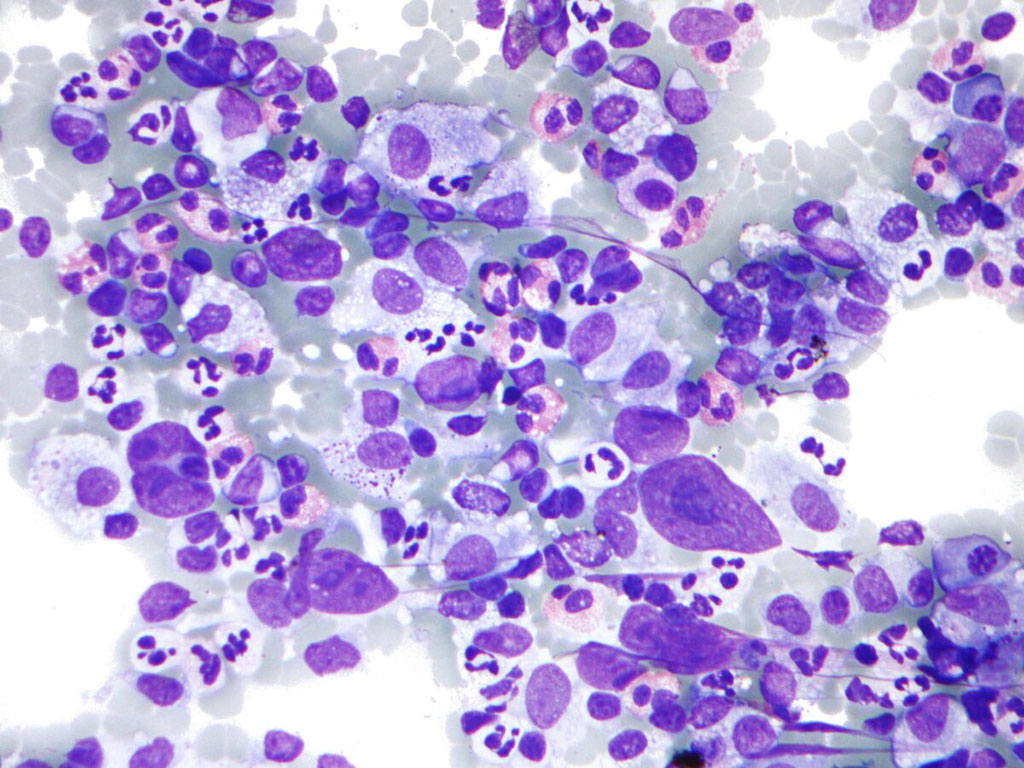 Image: Photomicrograph of Hodgkin lymphoma (HL), from a fine needle aspiration of a lymph node, which shows a mixture of cells common in HL: Eosinophils, Reed-Sternberg cells, Plasma cells, and Histocytes (Photo courtesy of Nephron).