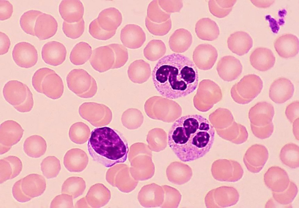Image: A blood film with a normal mature lymphocyte with a single large nucleus is seen on the left, compared to two segmented neutrophils on the right with multiple nuclear lobes. The lymphocytes are decreased in comorbid diabetes and COVID-19 patients (Photo courtesy of Ed Reschke).