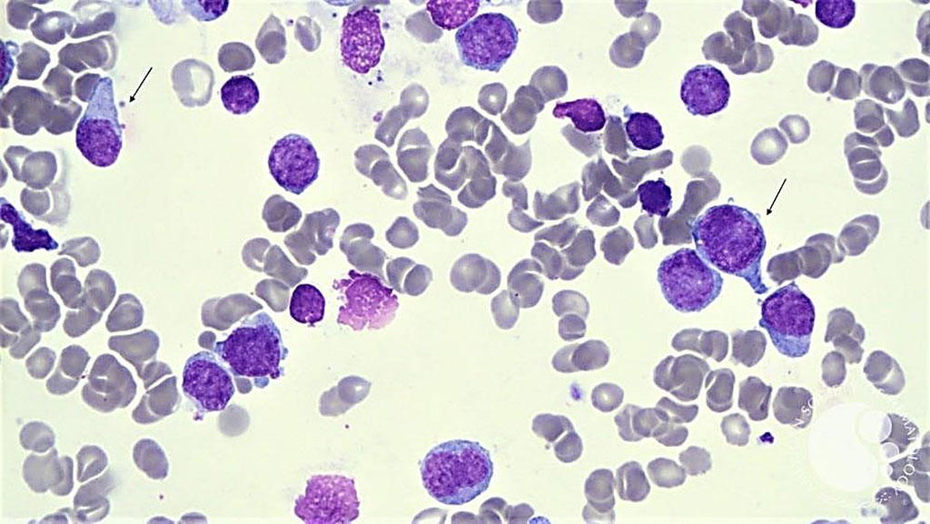 Image: Bone marrow smear in T-cell acute lymphoblastic leukemia shows pleomorphic blasts cells and smear cells. Two of the blasts have a hand-mirror conformation (arrows) (Photo courtesy of Ke Xu, MD).