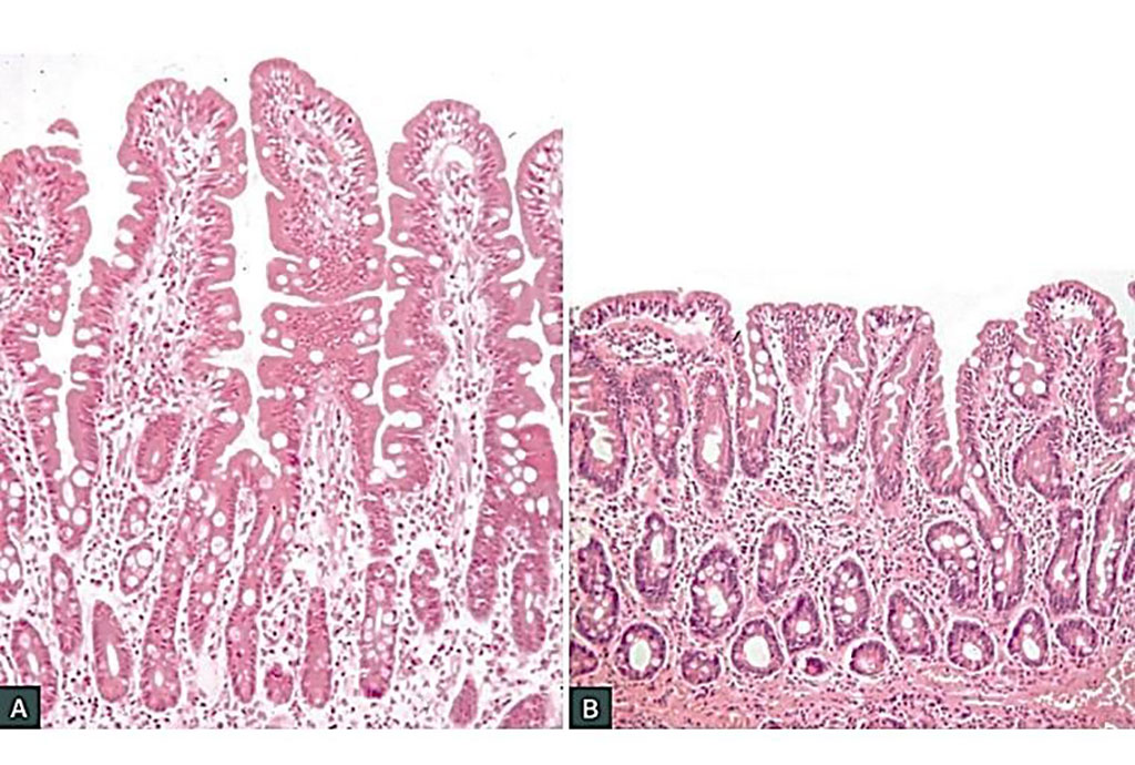 Image: Histology of normal small intestinal mucosa in adequately treated celiac disease (A). Untreated coeliac disease shows the classic triad of infiltration of the epithelium with lymphocytes, crypt hyperplasia and villous atrophy (B) (Photo courtesy of Professor Jason Tye-Din, MBBS PhD).