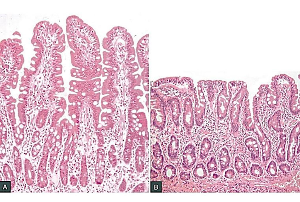 celiac disease histology