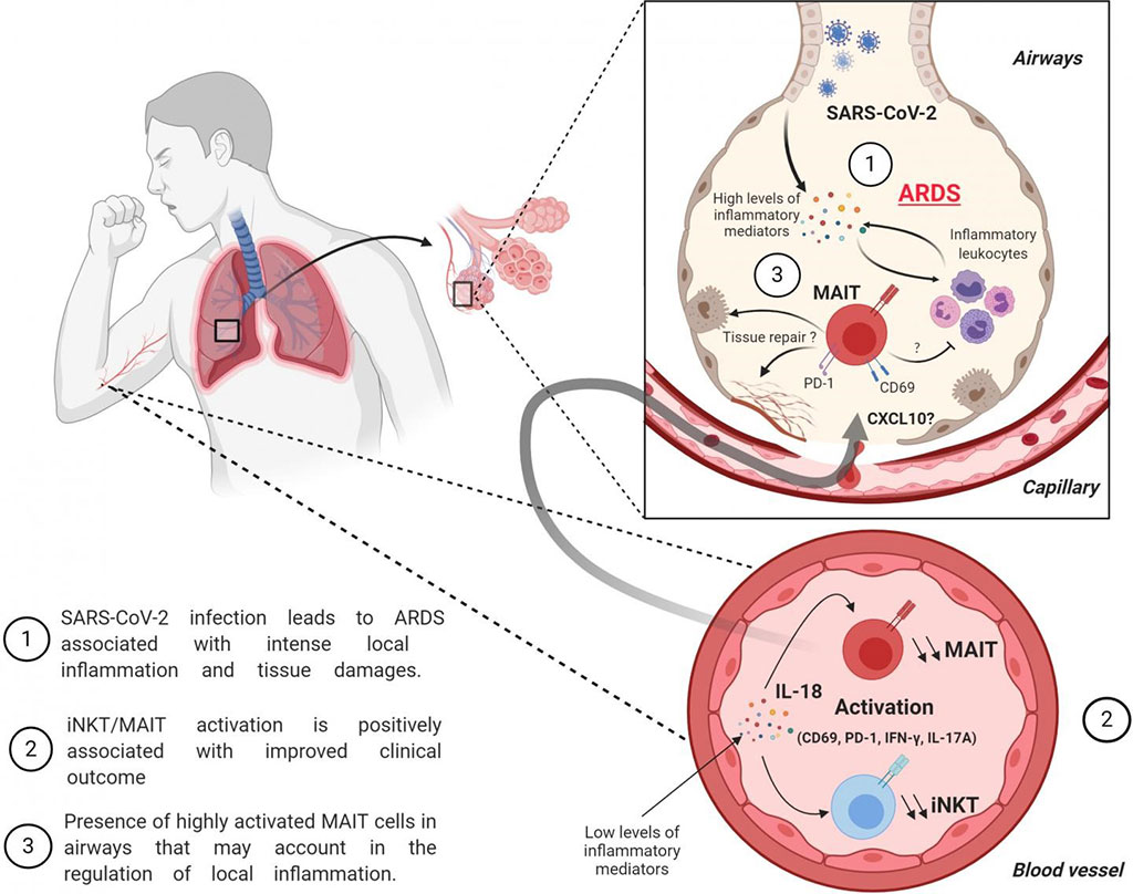 Image: Increased MAIT and iNKT cell activation is associated with improved outcome in severe COVID-19 patients (Photo courtesy of the University of Tours).