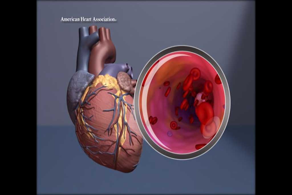 Image: Illustration of the heart with magnification of the artery (Photo courtesy of American Heart Association)