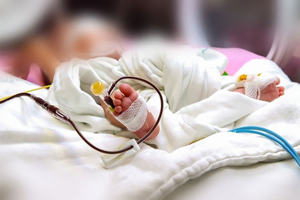 Image: A newborn baby’s foot with a peripheral intravenous catheter in the neonatal intensive care unit. Newborns undergoing surgery suffered worse outcomes if they had received preoperative blood transfusion (Photo courtesy of Atichayo).