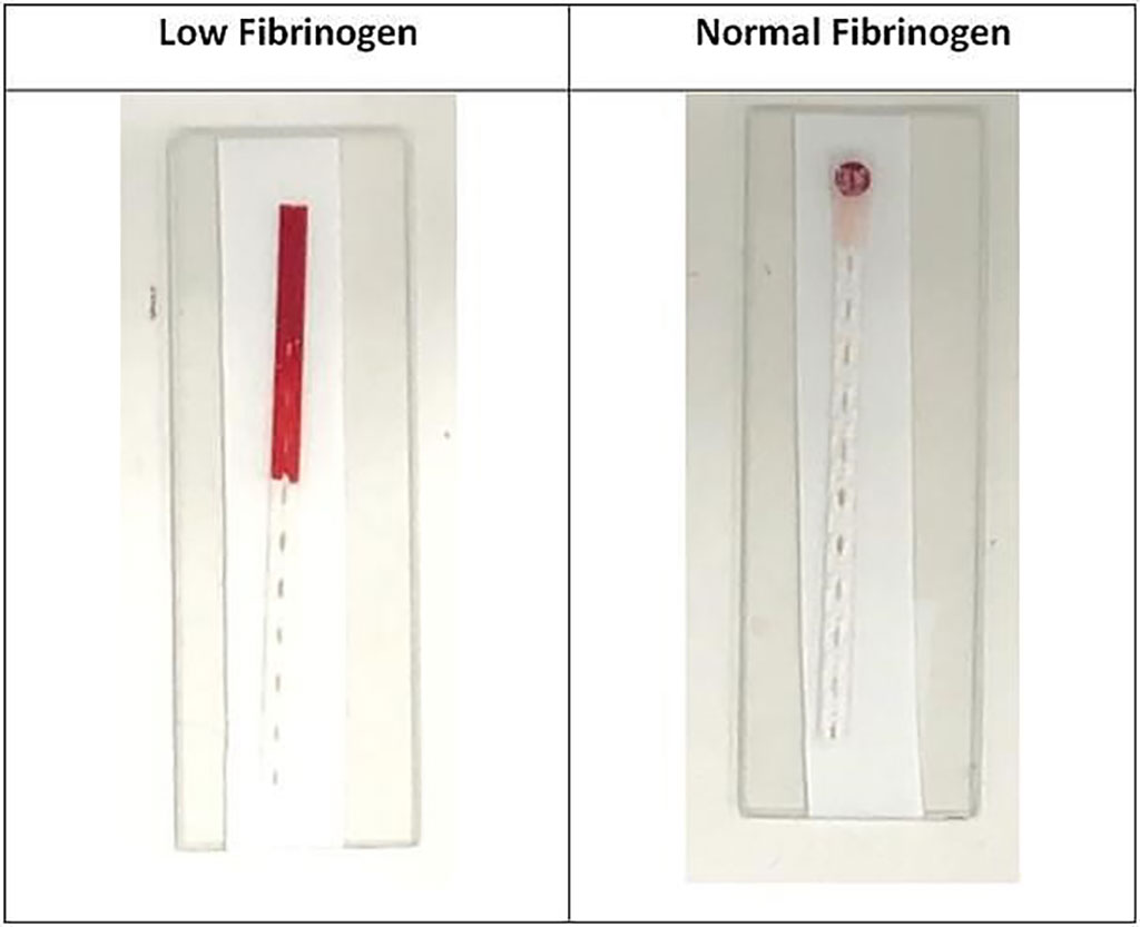 Image: Fibrinogen Test: people with low fibrinogen levels show a rapid movement of blood up the device (Photo courtesy of Monash University).