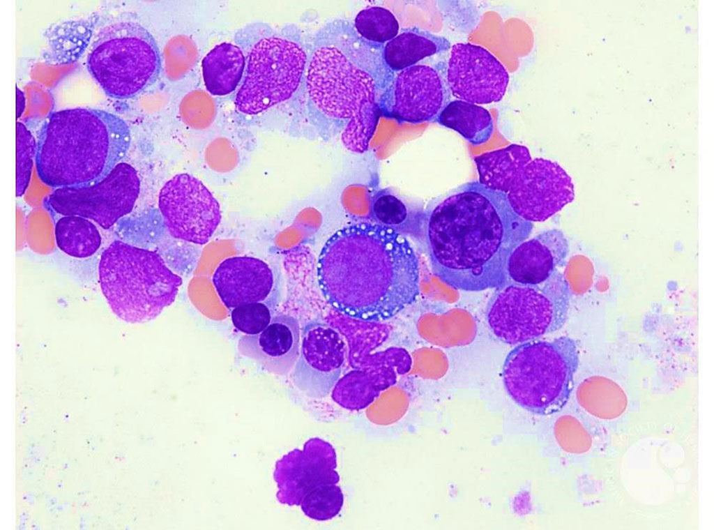 Image: Vacuolated erythroid precursors in the bone marrow are sometimes found in patients with severe adult-onset autoinflammatory disorder (Photo courtesy of Teresa S. Scordino, MD).