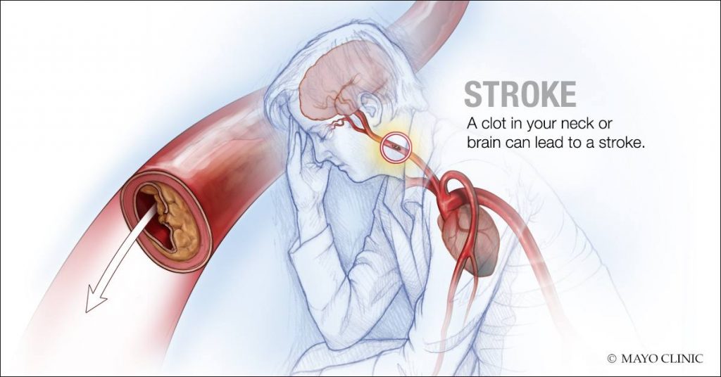 Image: A clot in the neck or brain can lead to a stroke (Photo courtesy of Mayo Clinic)