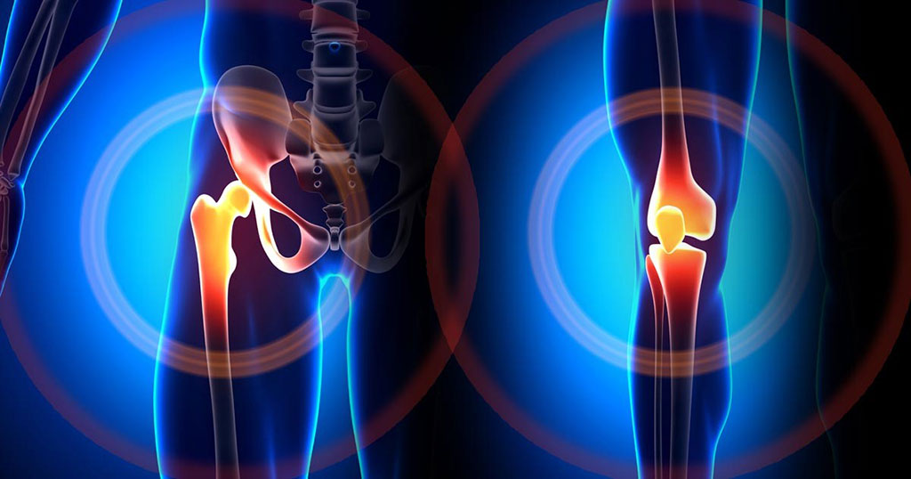 Image: Elevated fructosamine levels were associated with increased periprosthetic joint infection risk (Photo courtesy of Kristine Houck, MA).