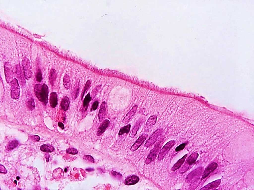 Image: Appearance of a `false brush border` of Brachyspira pilosicoli cells attached by one cell end to the luminal surface of human colonic enterocytes in a patient diagnosed with human intestinal spirochetosis (Photo courtesy of David J. Hampson, PhD, DSc).
