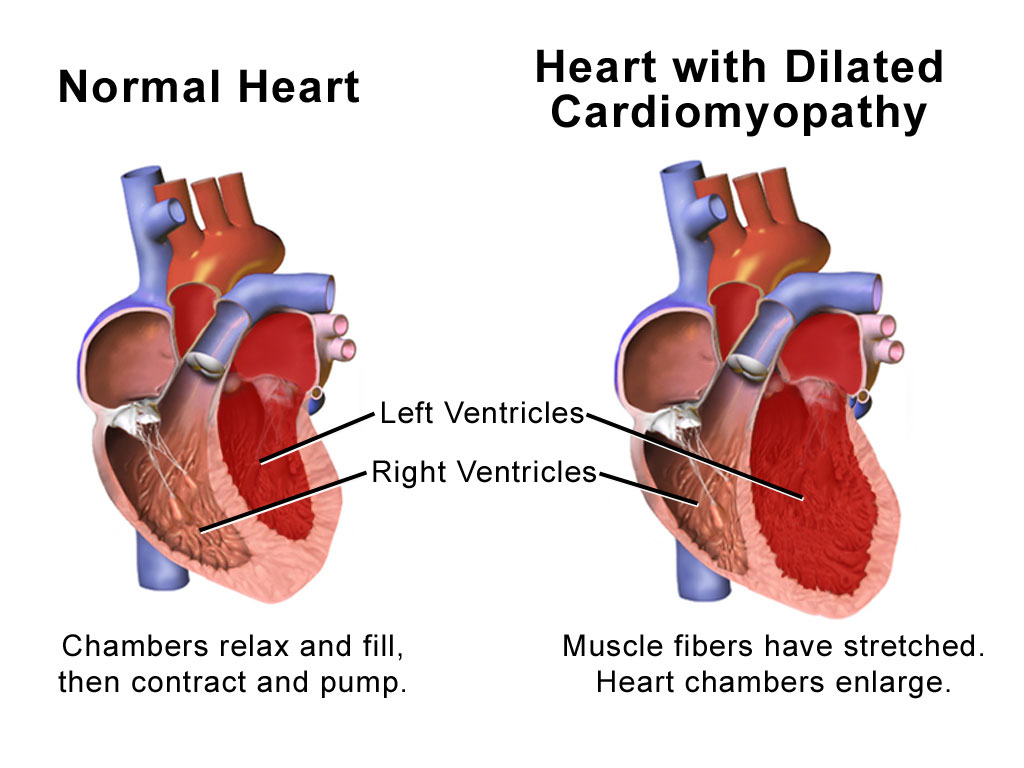 Image: Illustration of Normal Heart versus Heart with Dilated Cardiomyopathy (Photo courtesy of Medical gallery of Blausen Medical).