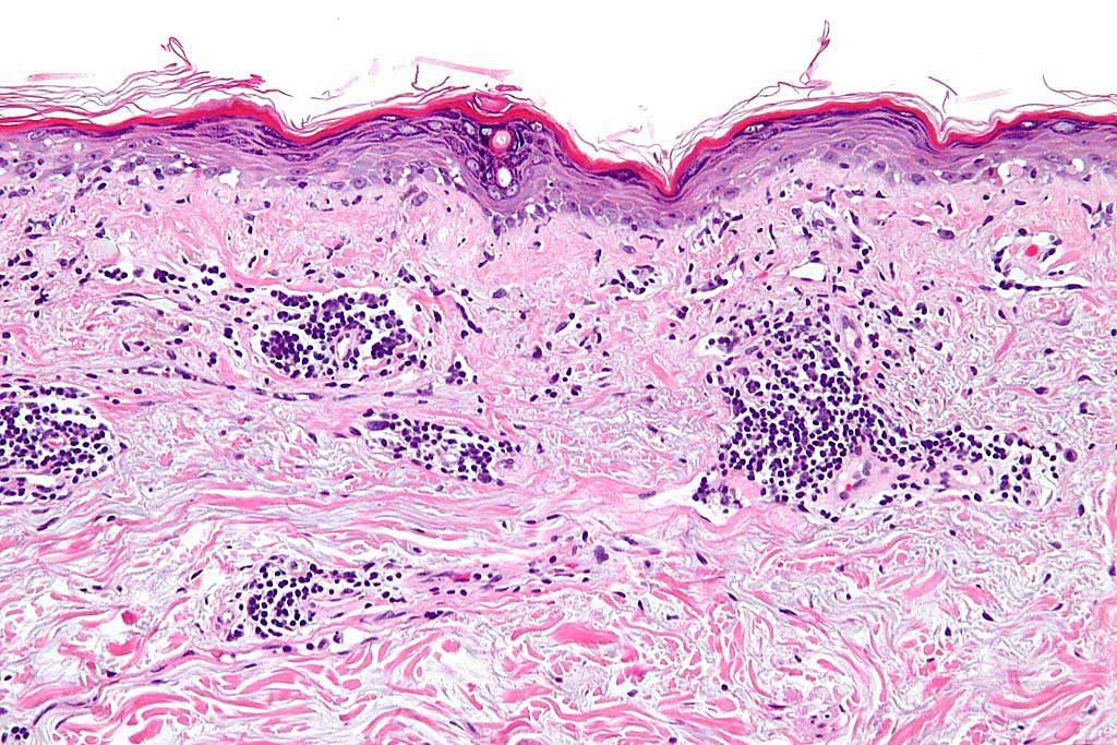 Image: Photomicrograph of a section of human skin showing a vacuolar interface dermatitis with dermal mucin. These findings are consistent with discoid skin lesions in lupus dermatitis (Photo courtesy of Nephron).