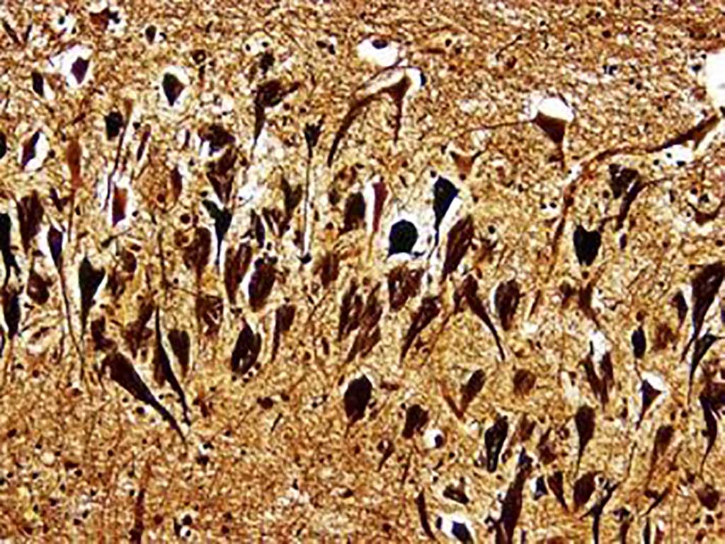 Image: Histopathology of neurofibrillary tangles in the brain of a patient with Alzheimer`s disease (Bielschowski silver stain) (Photo courtesy of Dimitri P. Agamanolis, MD).