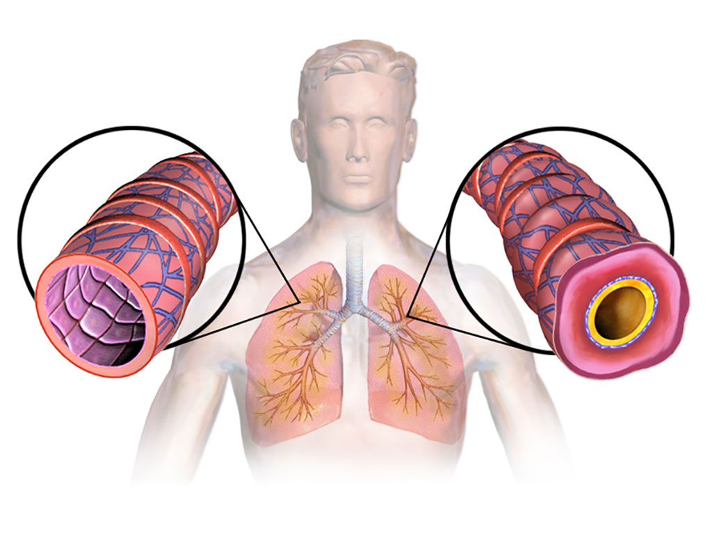 Image: Diagram of asthma (Photo courtesy of Wikimedia Commons)